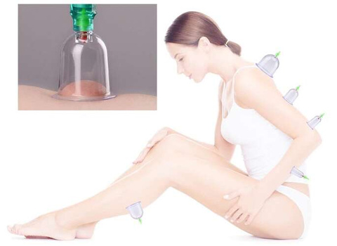 Chinese vacuum cupping